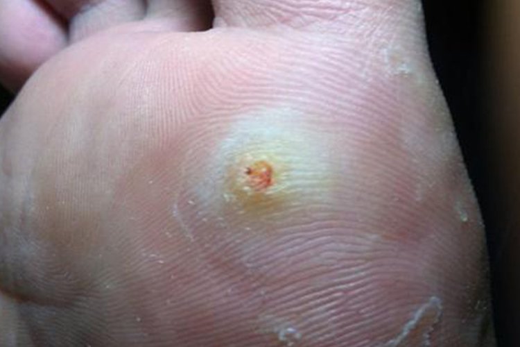 脚底皮肤病图片大全