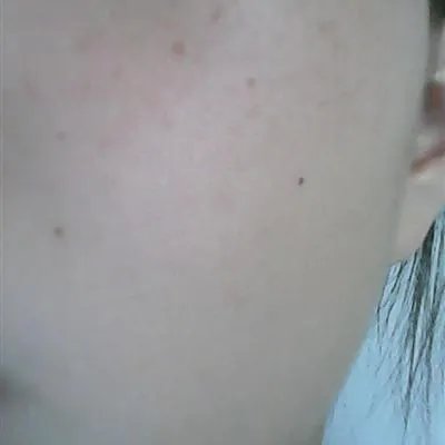 黄褐斑做激光能去掉吗?