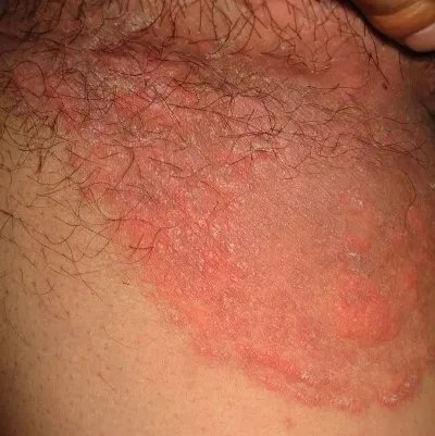 女性股癣图片初期图片