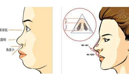 深圳哪家医院假体隆鼻好