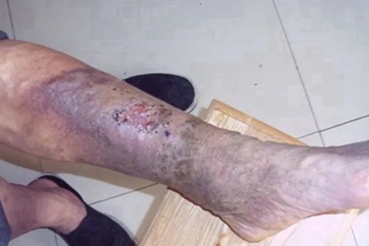 炭疽病小腿症状图片