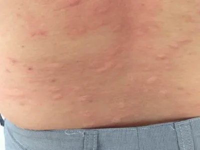 成人Still病症状图片