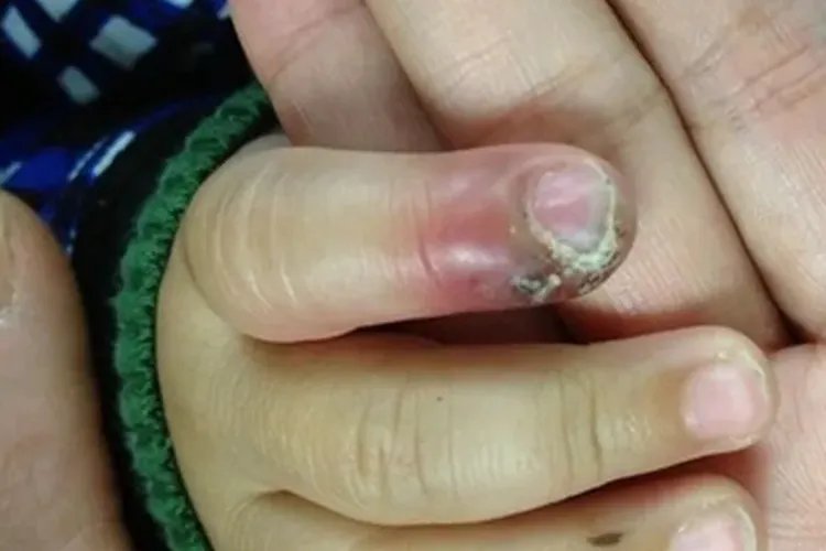 小儿慢性肉芽肿病图片