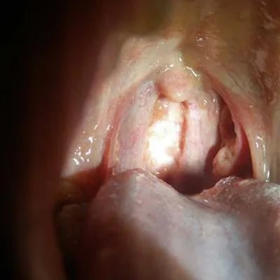 疱疹性咽颊炎怎么治疗?