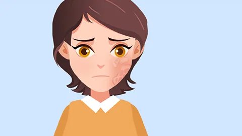 激素依赖性皮炎怎么治