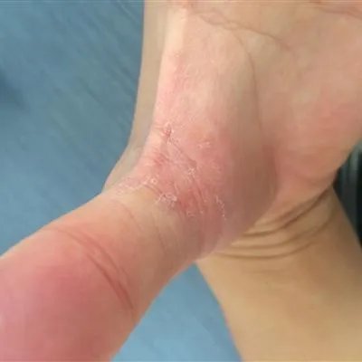 汗疱疹是什么原因引起的?