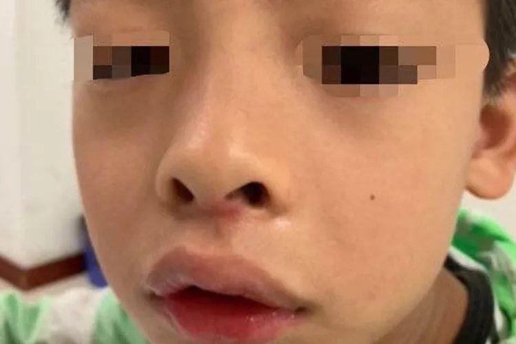 腺样体肥大的面容图片