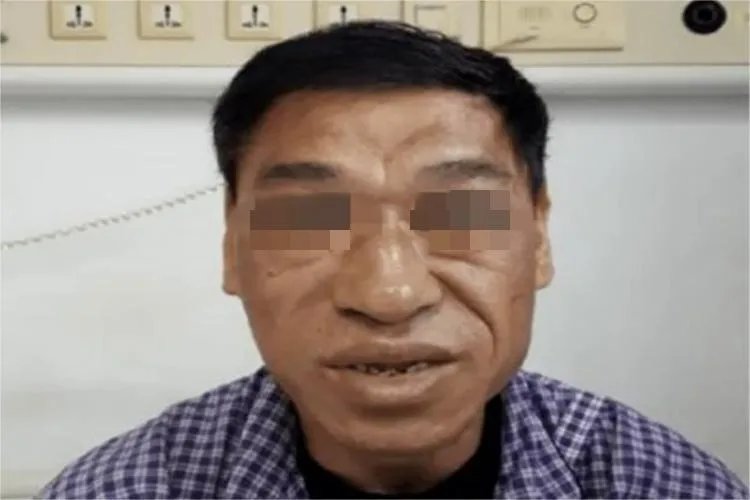 肢端肥大症面部症状图片