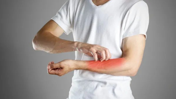 人工荨麻疹怎么治疗