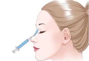 注射隆鼻的优势