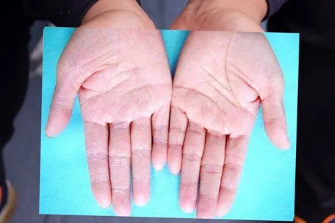 水疱疹如何治疗