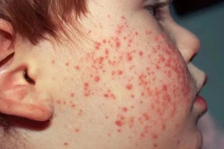 幼儿急疹的症状图片