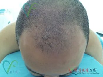 整形案例：揭秘毛发种植全过程