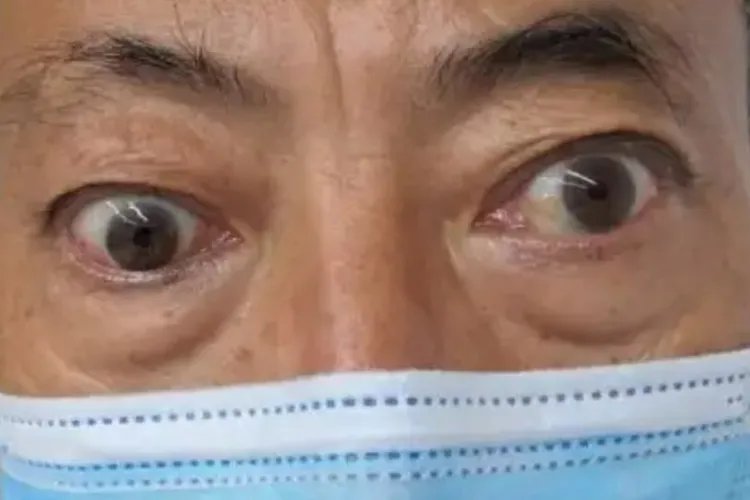 甲亢是什么样的病,严重吗