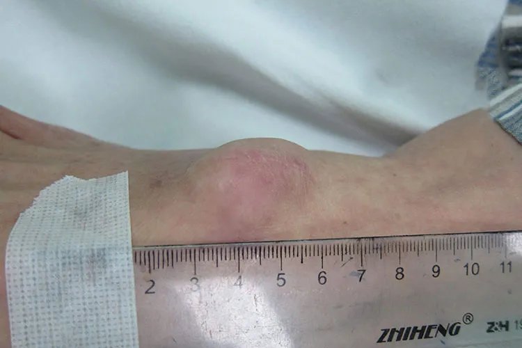 脚背腱鞘囊肿图片