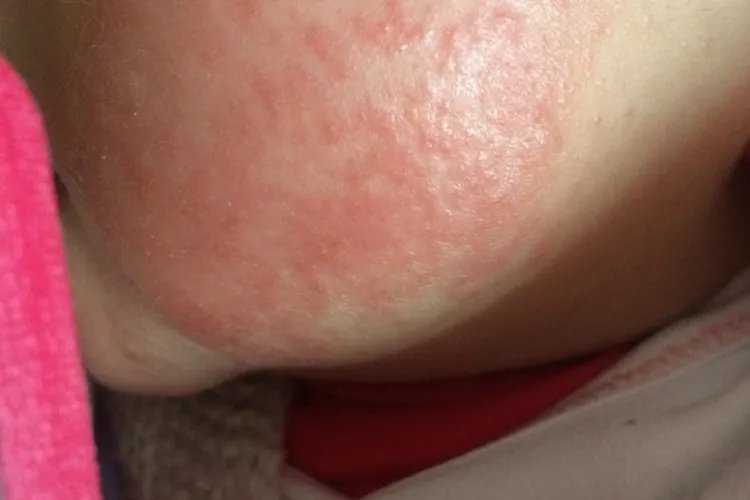 婴儿湿疹刚开始的图片