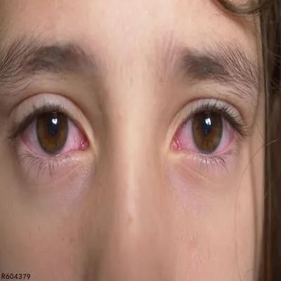 眼睛过敏性结膜炎怎么办