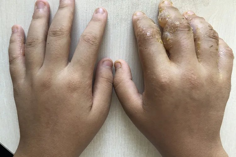 汗疱疹的症状图片