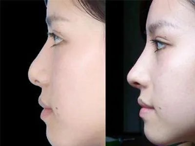 玻尿酸注射隆鼻的价格多少