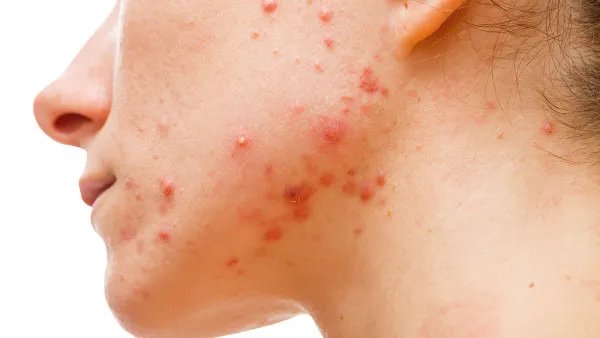 青春痘的治疗费用