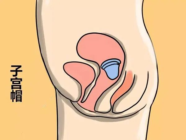 子宫帽使用步骤四部曲，正确涂抹胶冻是关键