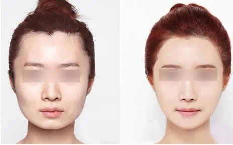 瘦脸针打一针要多少钱