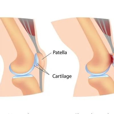 类风湿关节炎症状