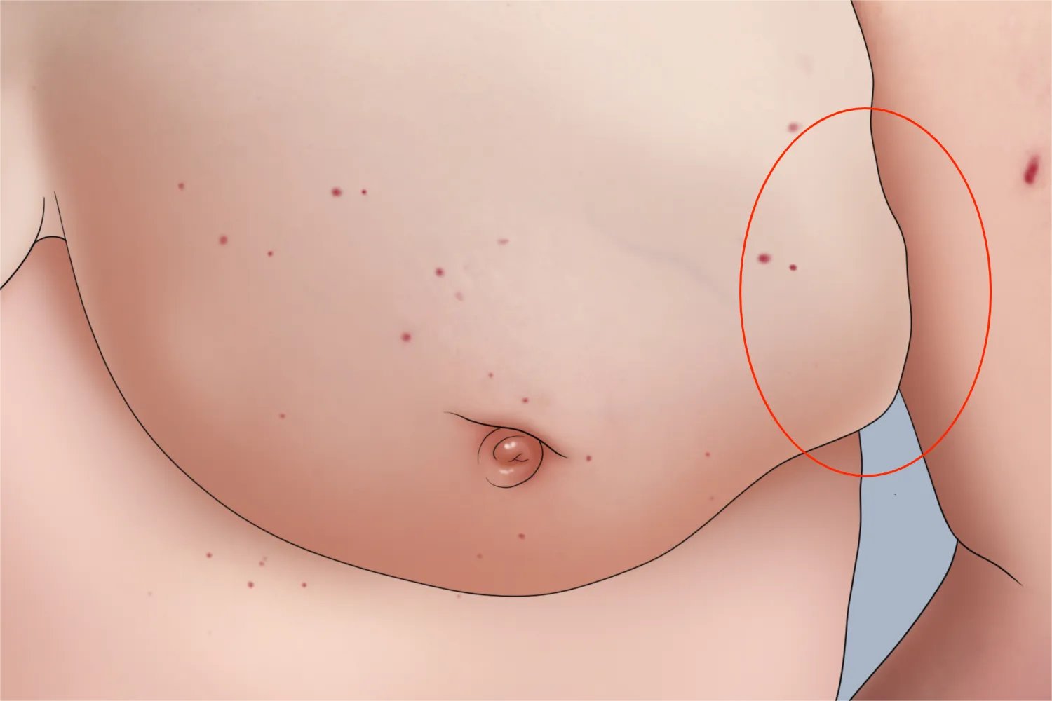 乳腺恶性肿瘤图片