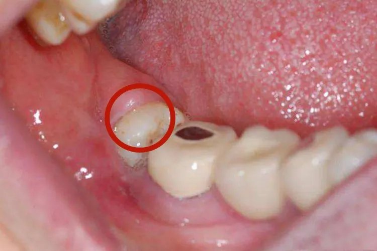 牙齿横着长在牙龈图片