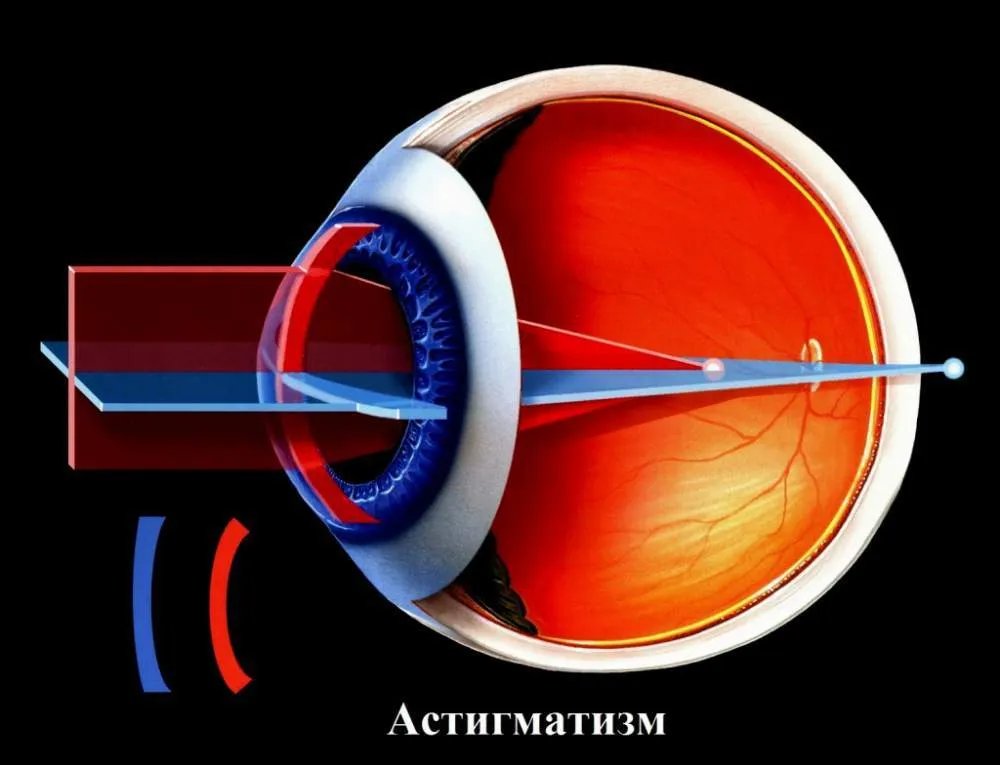 散光是怎么回事？