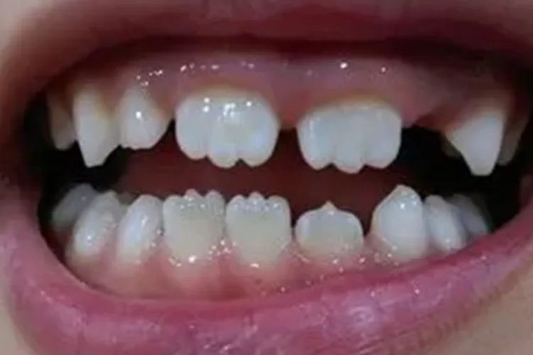 牙齿有小波浪图片