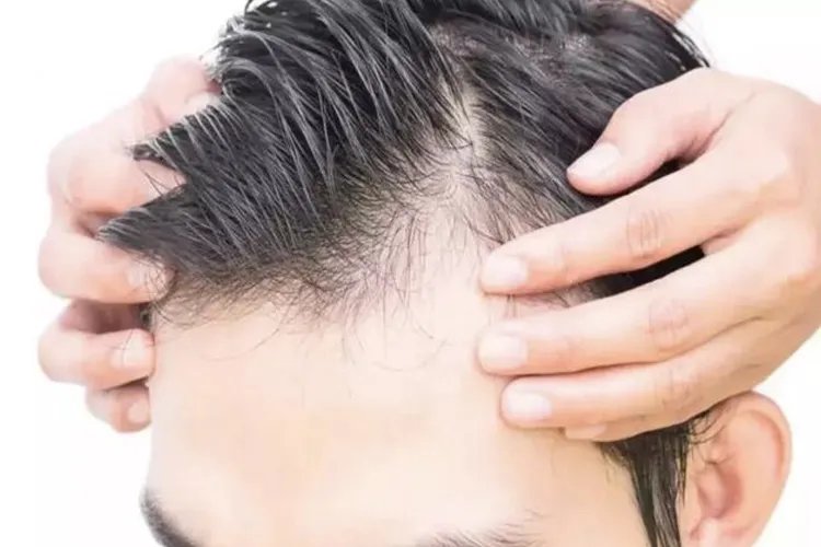 脱发1-7级程度图片