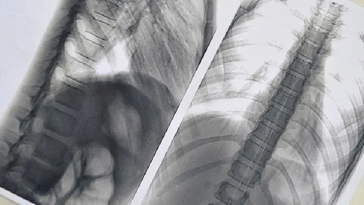 小细胞肺癌的危害通常有哪些