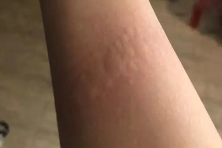 过敏性皮炎图片