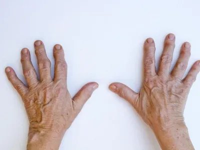 成人Still病症状图片