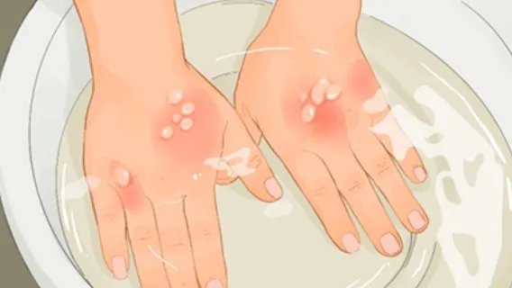 手上老年斑怎么去掉