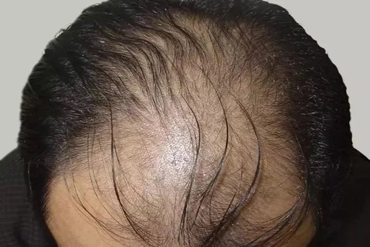 脱发1-7级程度图片