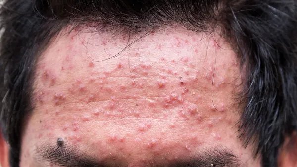 囊肿性痤疮怎么治疗