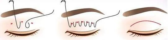 北京做埋线双眼皮多少钱，我先谢谢了