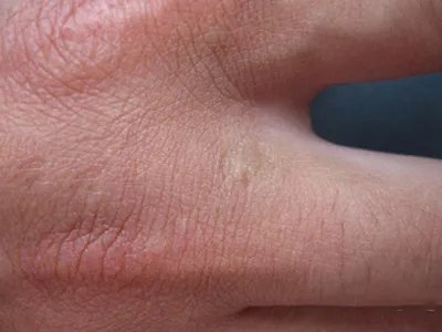 Pasini-Pierni进行性特发性皮肤萎缩斑图片