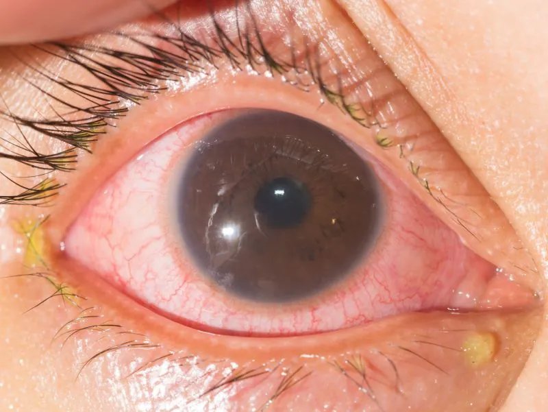 有色隐形眼镜的注意事项