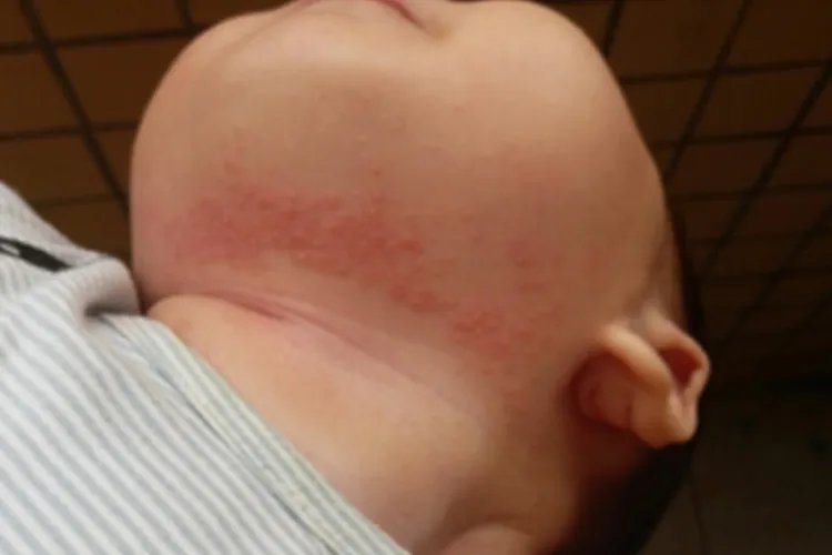 宝宝脖颈处湿疹图片