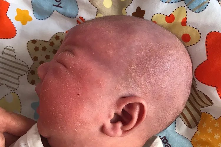 过敏性皮炎图片