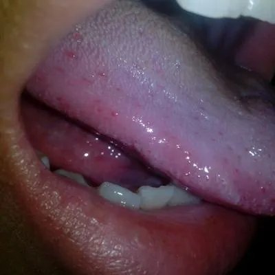 舌头疼是什么原因