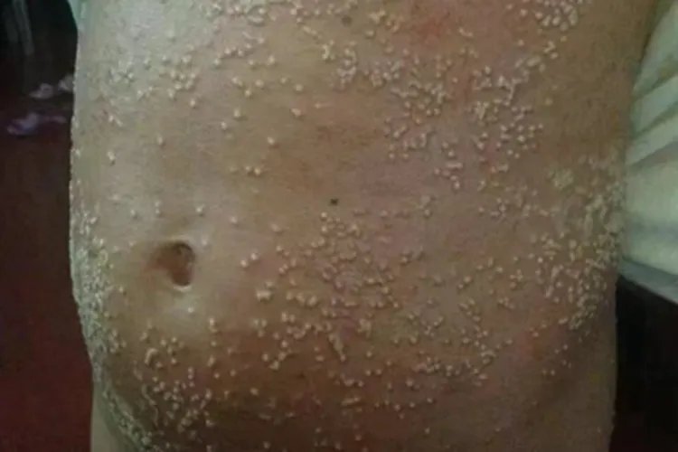 痱子小疙瘩图片