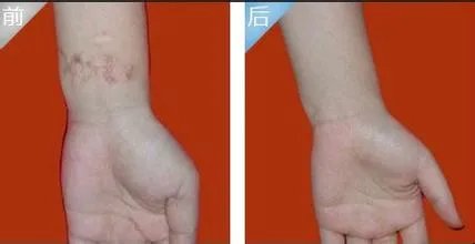手术后疤痕如何治疗