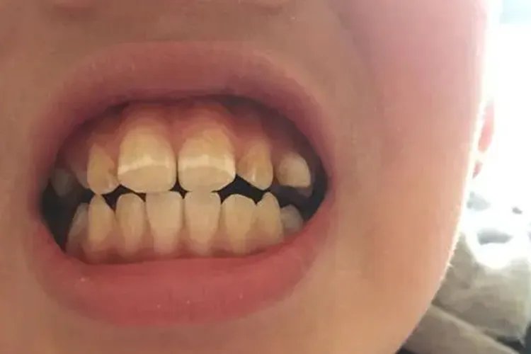 牙齿有小波浪图片