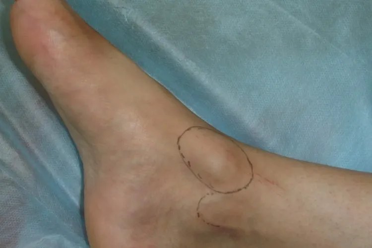 脚背腱鞘囊肿图片