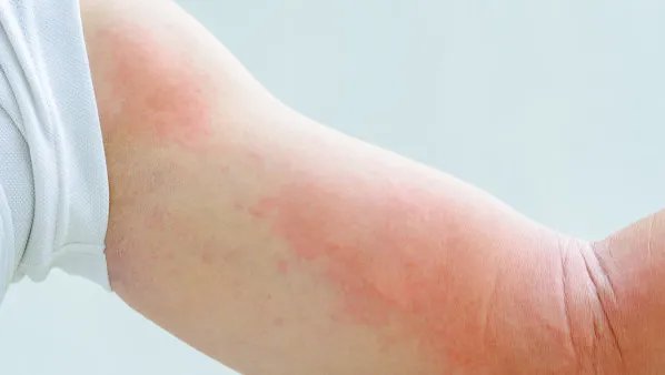 神经性皮炎的症状