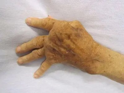 成人Still病症状图片